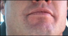 Newport Beach Bee Removal Guy Anthony right after being stung on the lip.