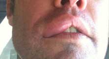 Anaheim Bee Removal Guy Anthony picture of swelling after being stung 
    on the lip.