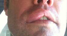 Yorba Linda Bee Removal Guy Anthony picture of swelling after being stung 
    on the lip.